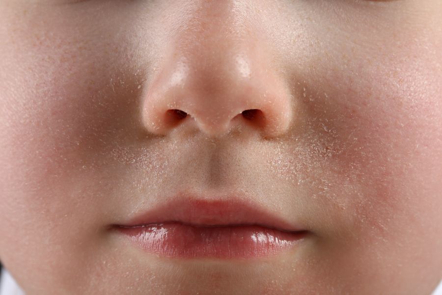 Close-up of a child's face with dry skin